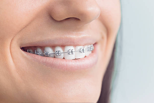Dental Bonding in Emerson, NJ